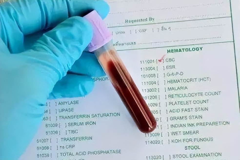 Have A Blood Routine Test In the blood routine examination, if these 4 indicators are elevated ...