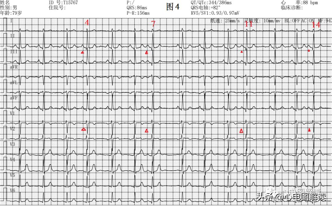 more subtle atrial premature beats iNEWS