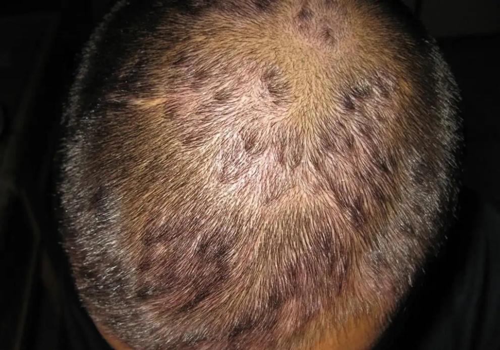 頭皮老是長疙瘩和膿包，或是這3種病在求救，並非排毒，別大意