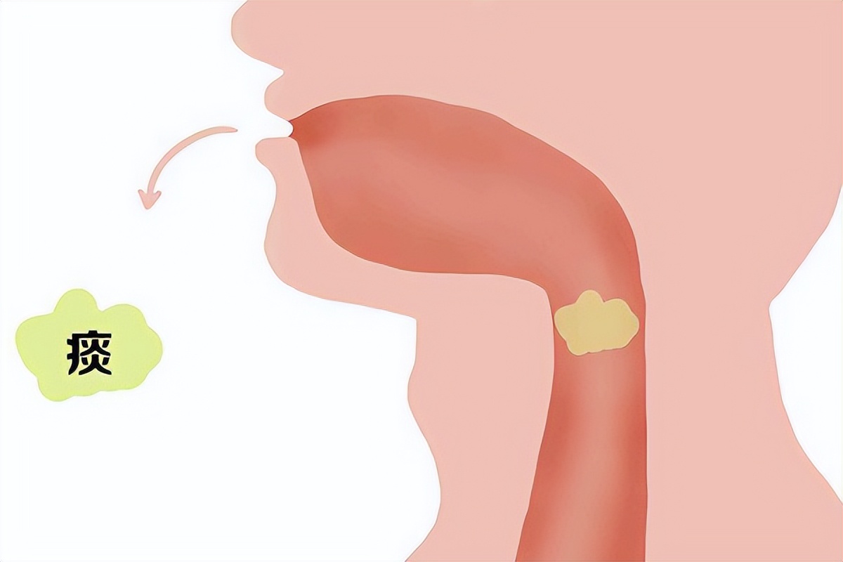 Clear phlegm in the lungs, sticky phlegm in the spleen, old phlegm in