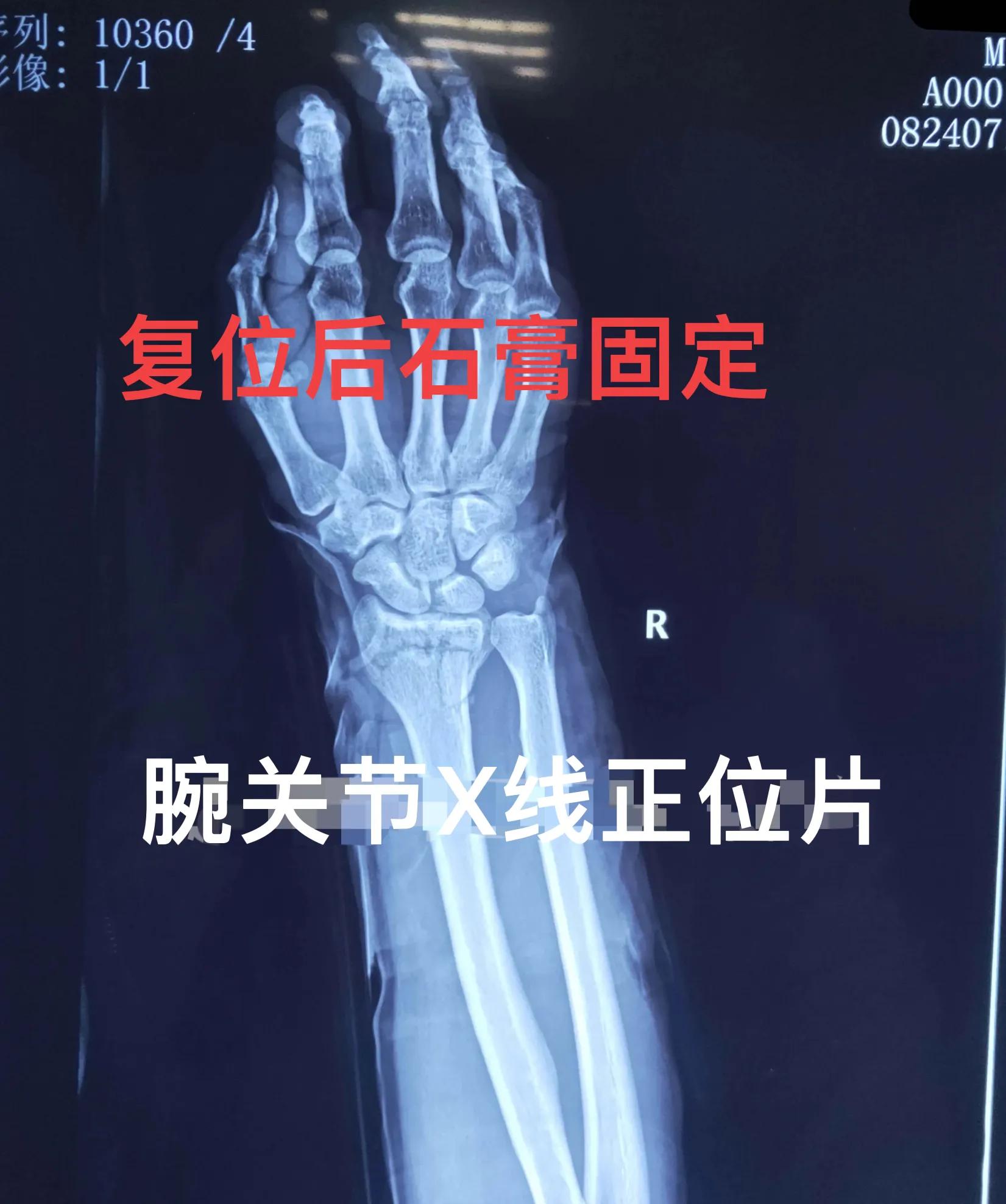 老年人腕部骨折手法复位石膏固定治疗方法指导 资讯咖
