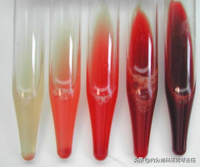 Diabetic nephropathy, urine occult blood iNEWS