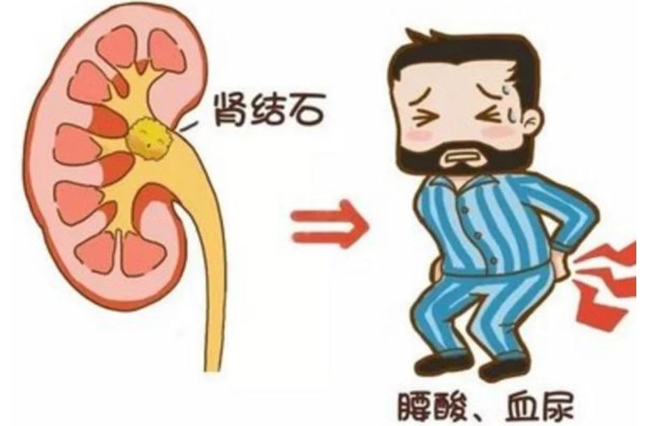 Kidney stones are boiled stones, why did they find you? iNEWS