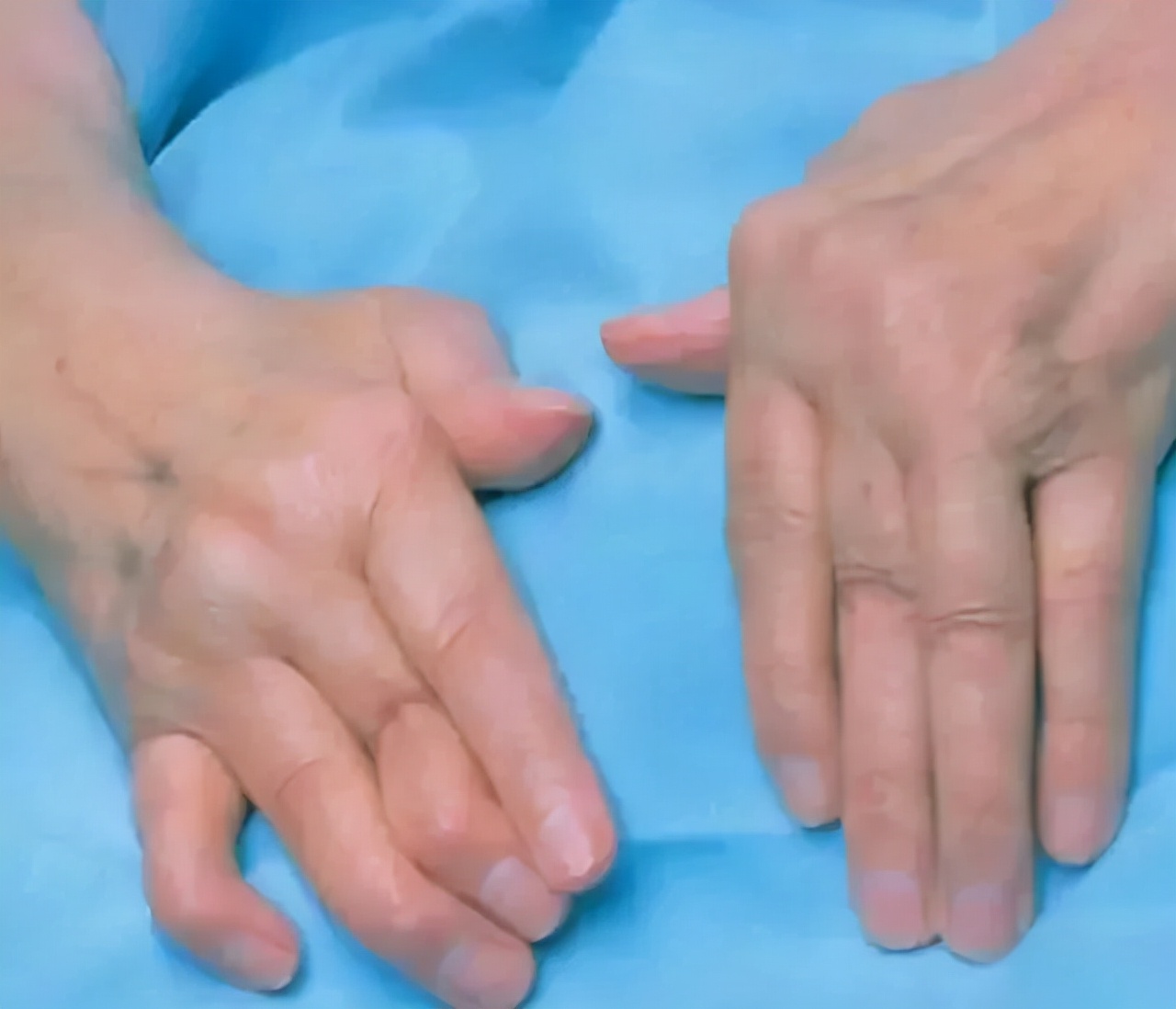 10 things you need to know about rheumatoid arthritis iMedia