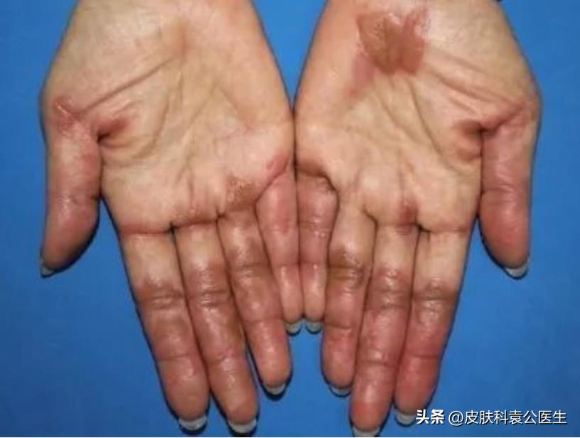 Ripe Therapy Rash What should I do if I have a rash with targeted therapy? - iNEWS