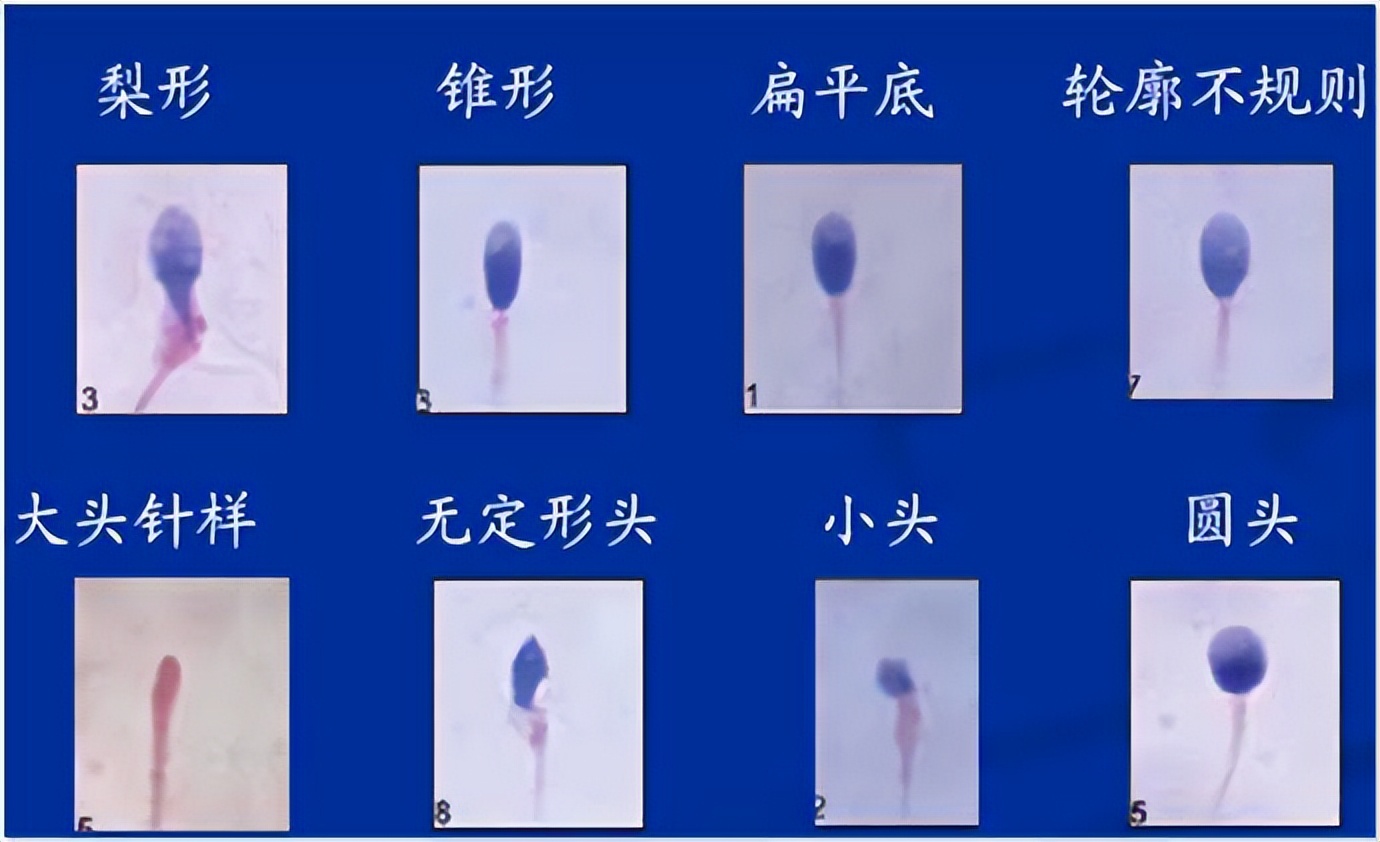 Sperm deformity rate is high, will there be deformed children? - iNEWS