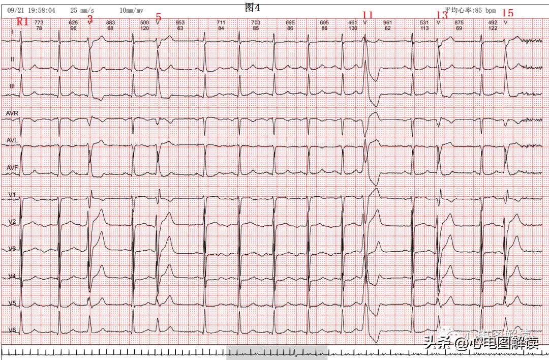 Two cases of premature ventricular contractions and ventricular ...