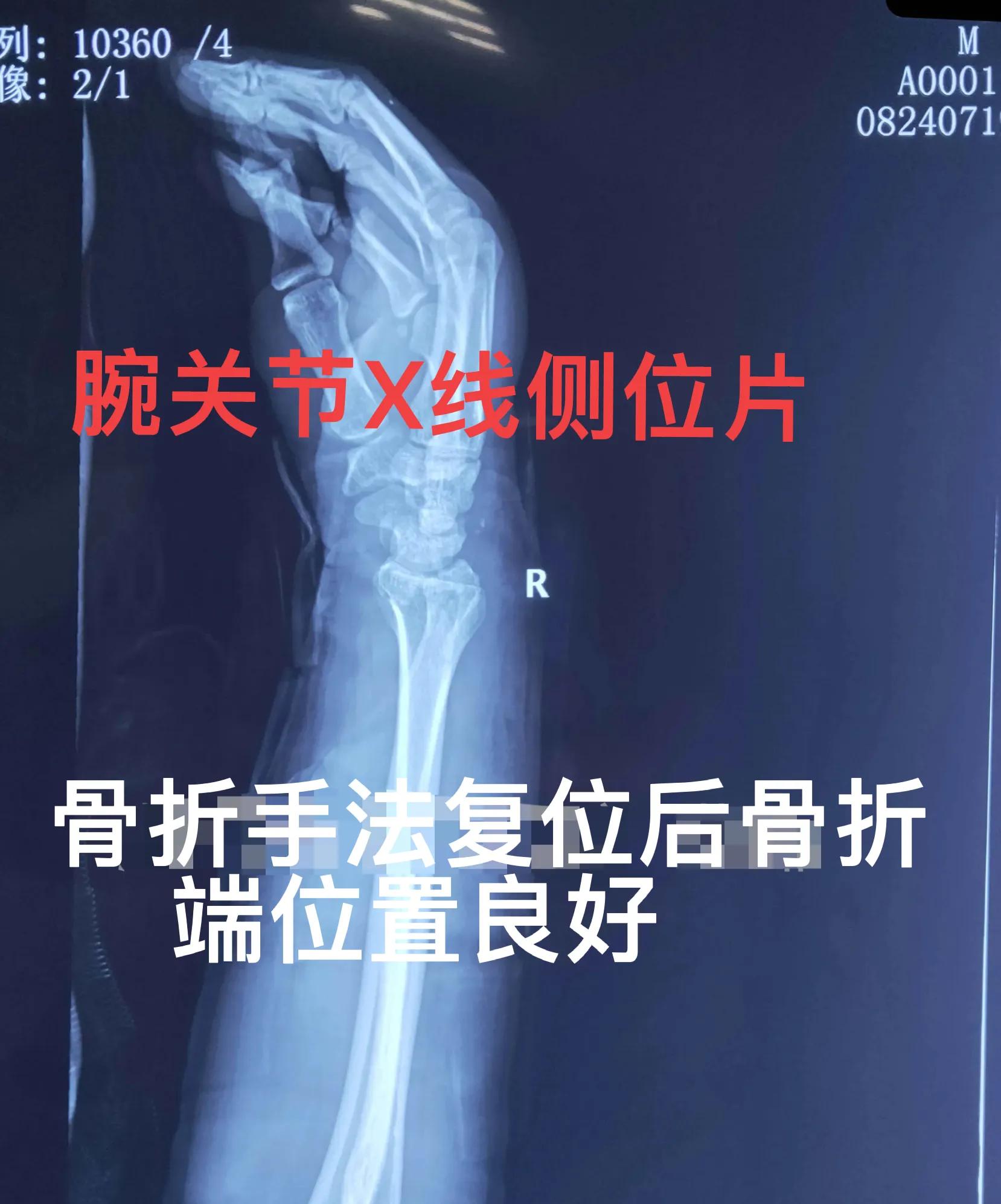 老年人腕部骨折手法复位石膏固定治疗方法指导 资讯咖