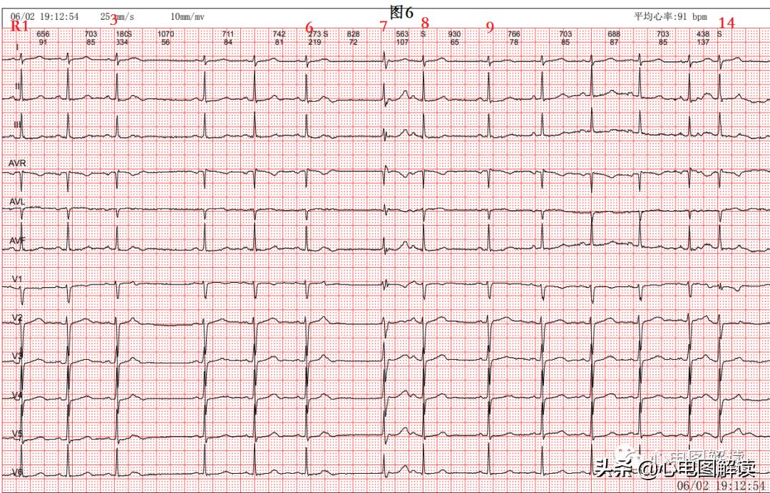 Atrial premature beat, atrial premature beat, scatter plot - iNEWS