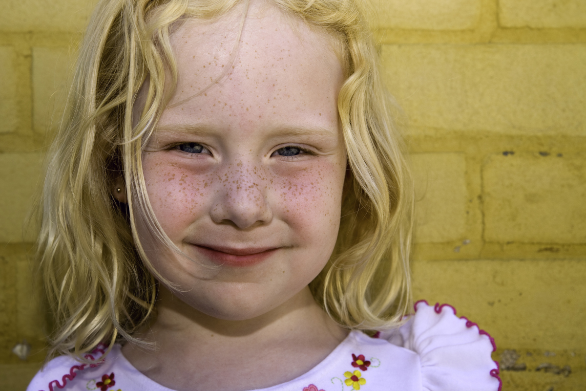Freckles, chloasma, and sunburn can't tell the difference?teach you how