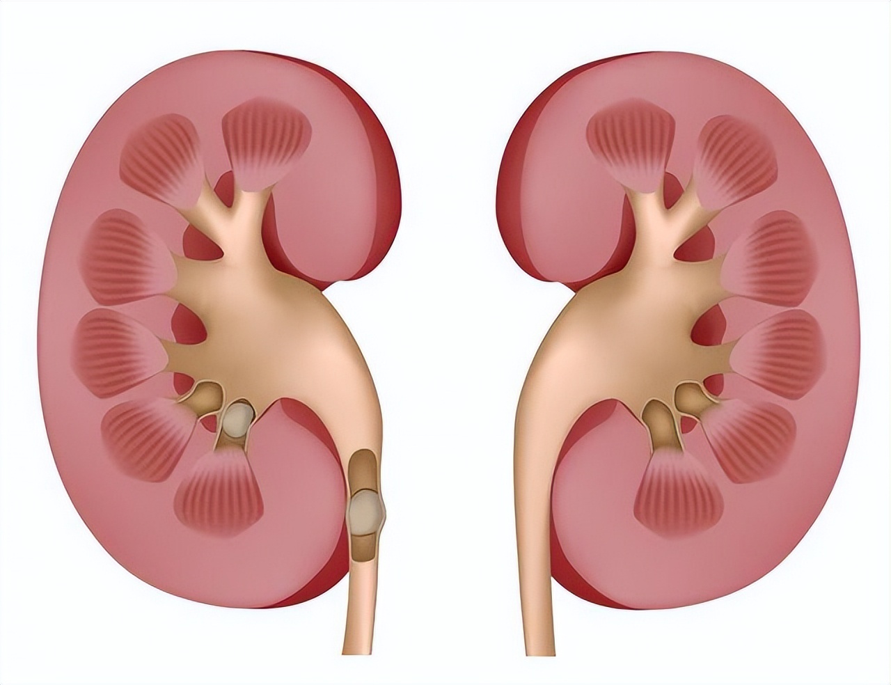 Will calcium supplementation cause kidney stones? iNEWS