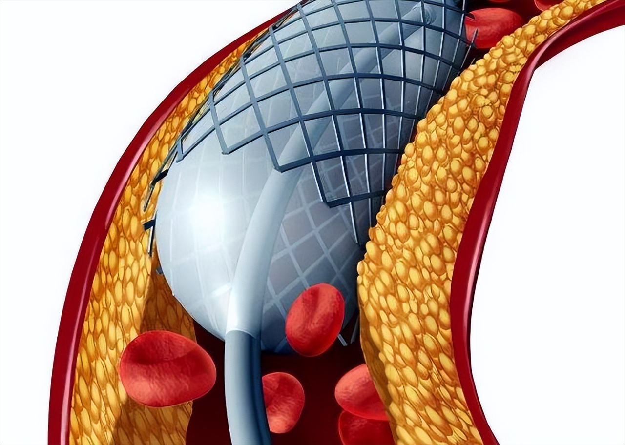 Will the installation of a heart stent affect the human body?How do you