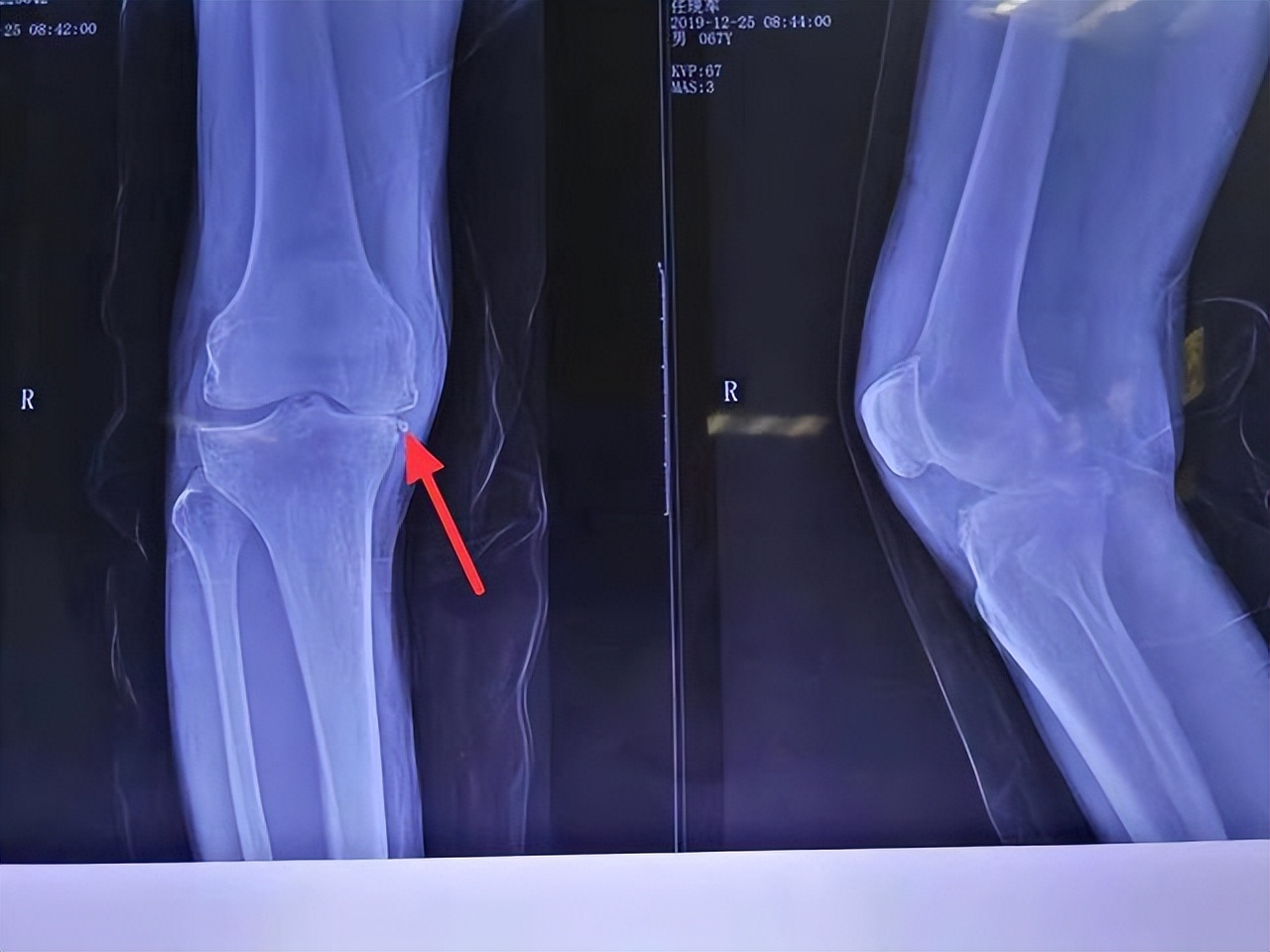 Are soy products the "bane" of gout? iNEWS