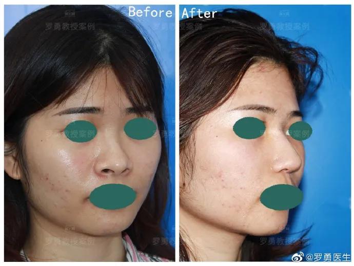 Large nostrils + wide nose wings + collapsed nose bridge iNEWS