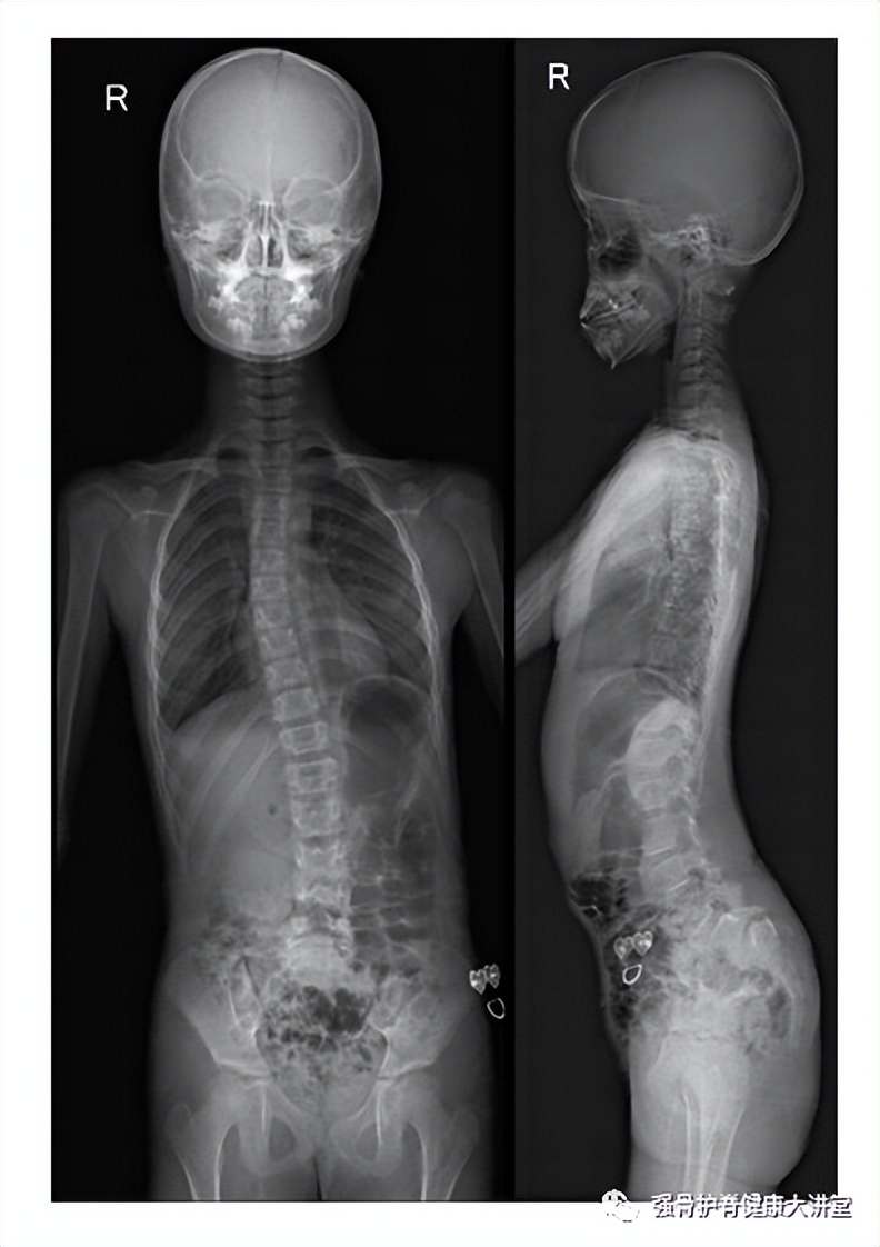 "Medical Science" Adolescent scoliosis may be caused by