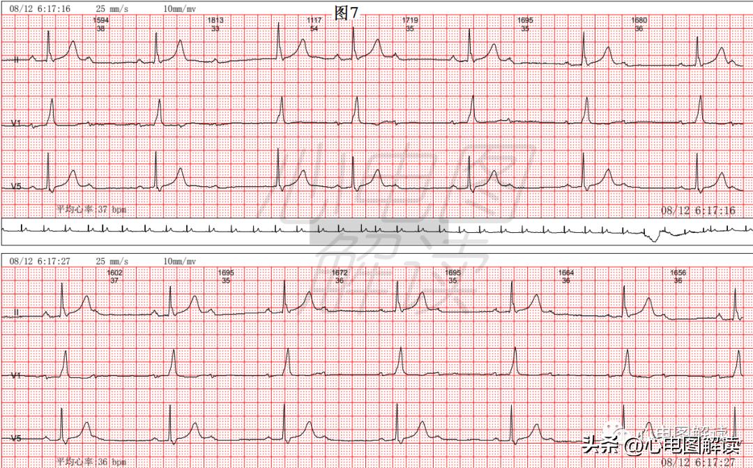 Complex and variable second-degree atrioventricular block, right bundle ...