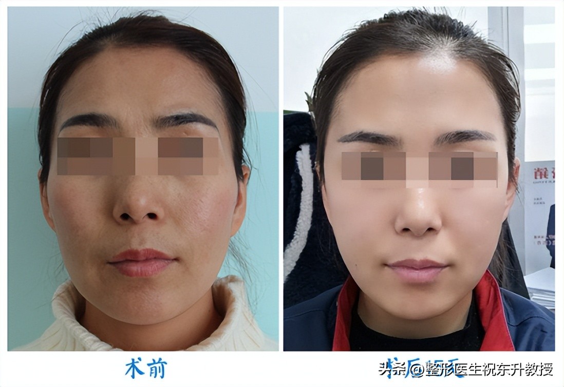 A full face makes you look younger!15day real record of autologous fat
