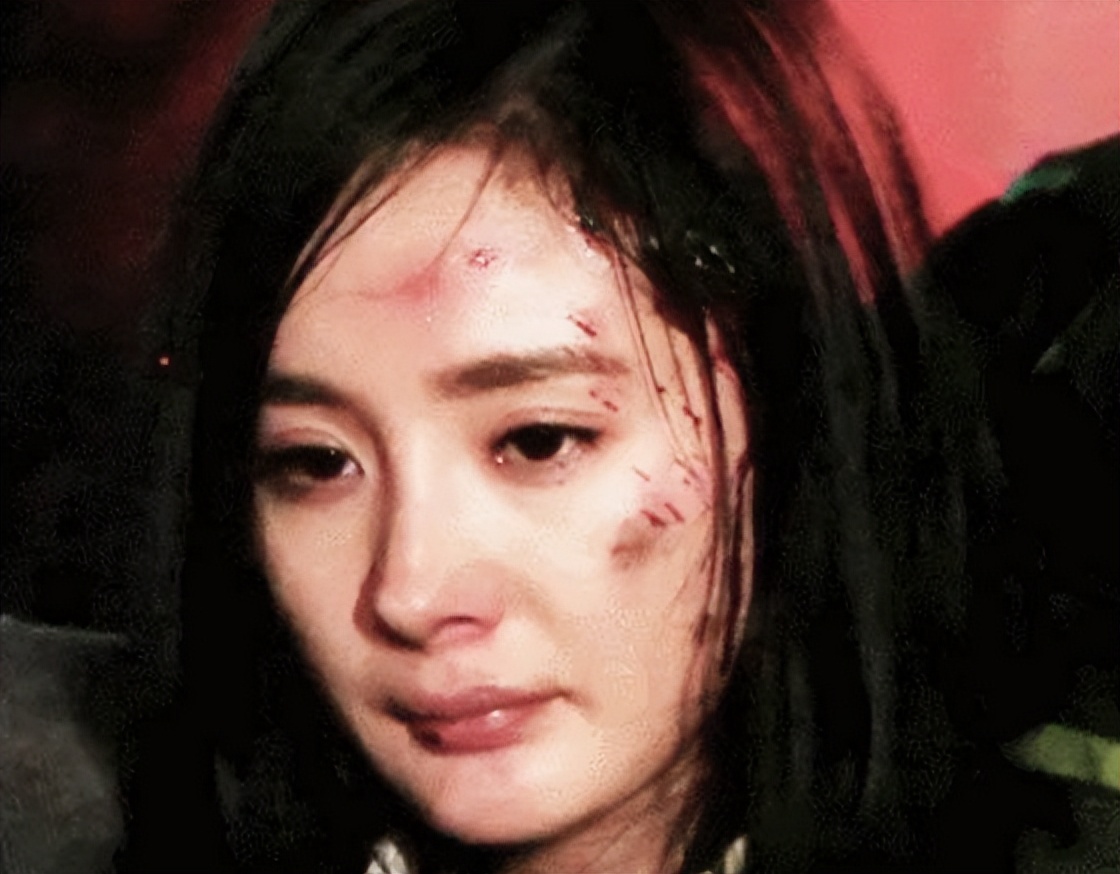 Yang Mi's injury status!The eye stitches need to be bandaged and the