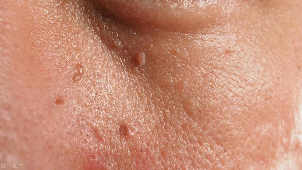 [Popular Science] The causes and treatment of flat warts, one way to