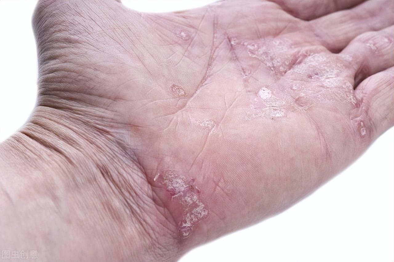 How Can Psoriasis Be Cured? - Inews