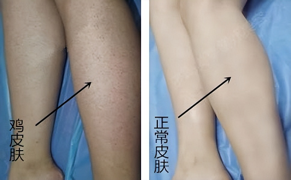 How to remove chicken skin completely iMedia