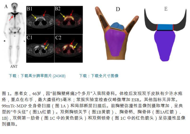 SAPHO syndrome whole body bone imaging 