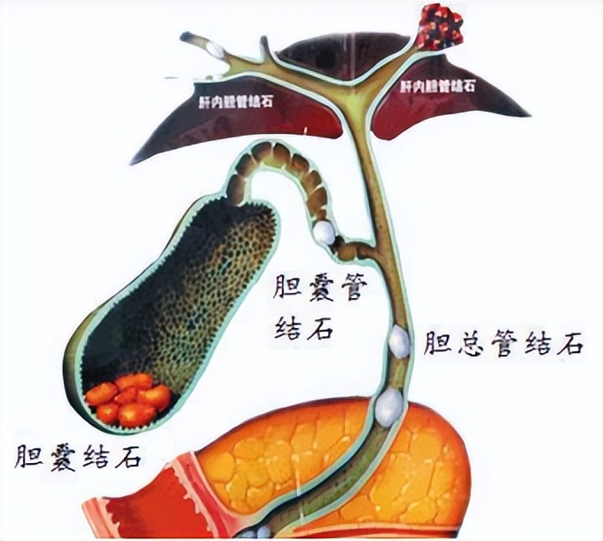 Heart disease encountered bile duct stones, minimally invasive