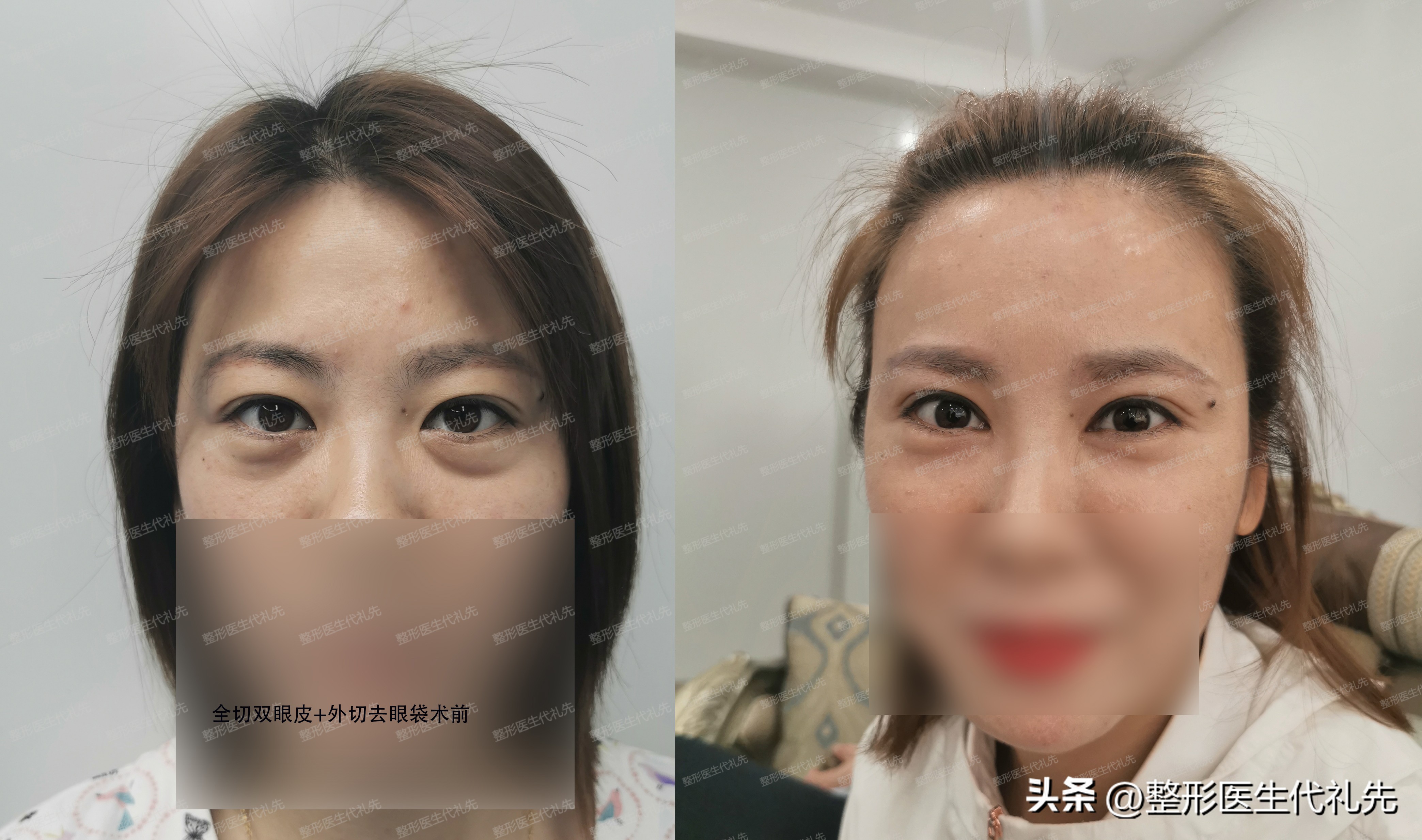 Eye bags What are the main causes of eye bags? iMedia