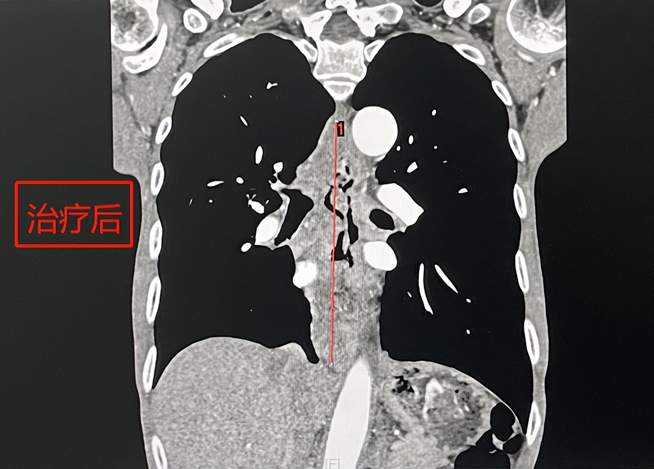 Uncle Su, a patient with esophageal cancer no more crying with braised