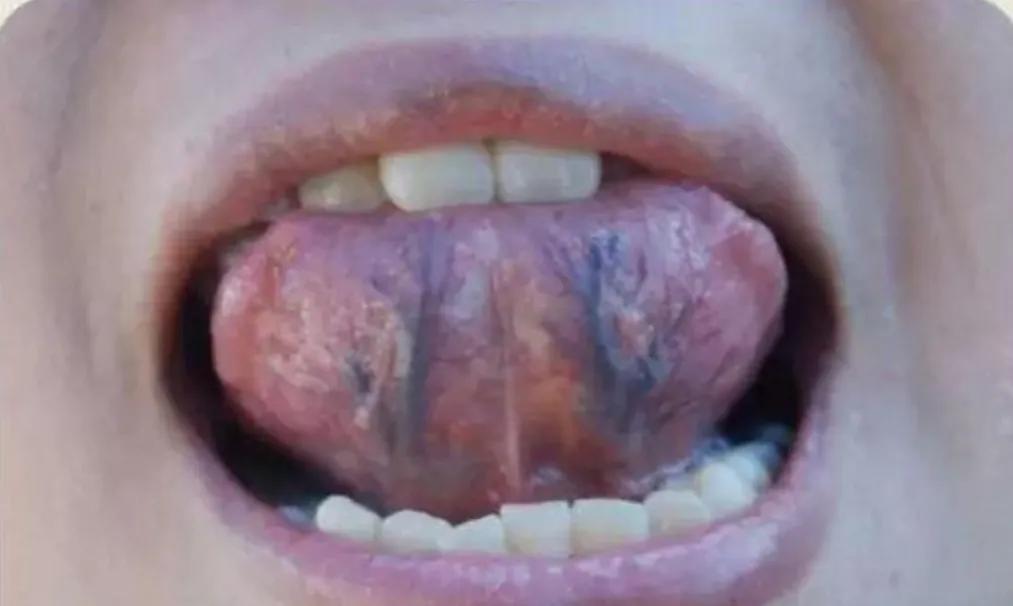 Liver stagnation and qi stagnation in all diseases iNEWS