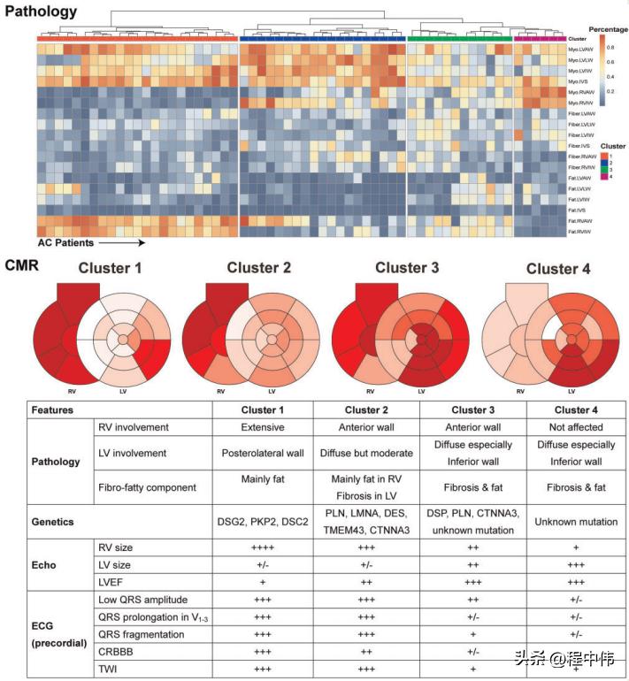 Arrhythmogenic Cardiomyopathy: A Gene-based Clinicopathological ...