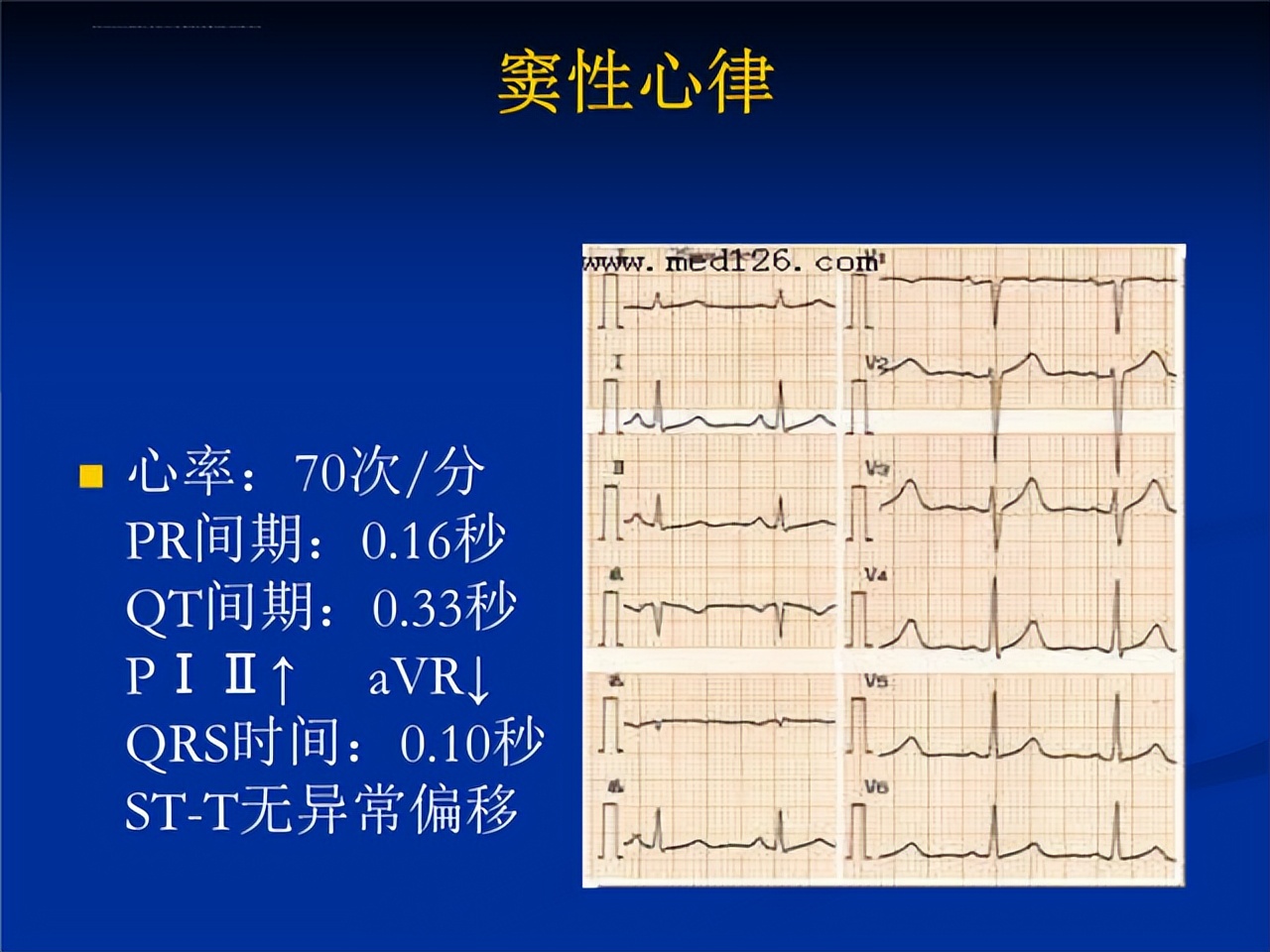 What Does sinus Rhythm Mean Is Arrhythmia A Heart Attack INEWS