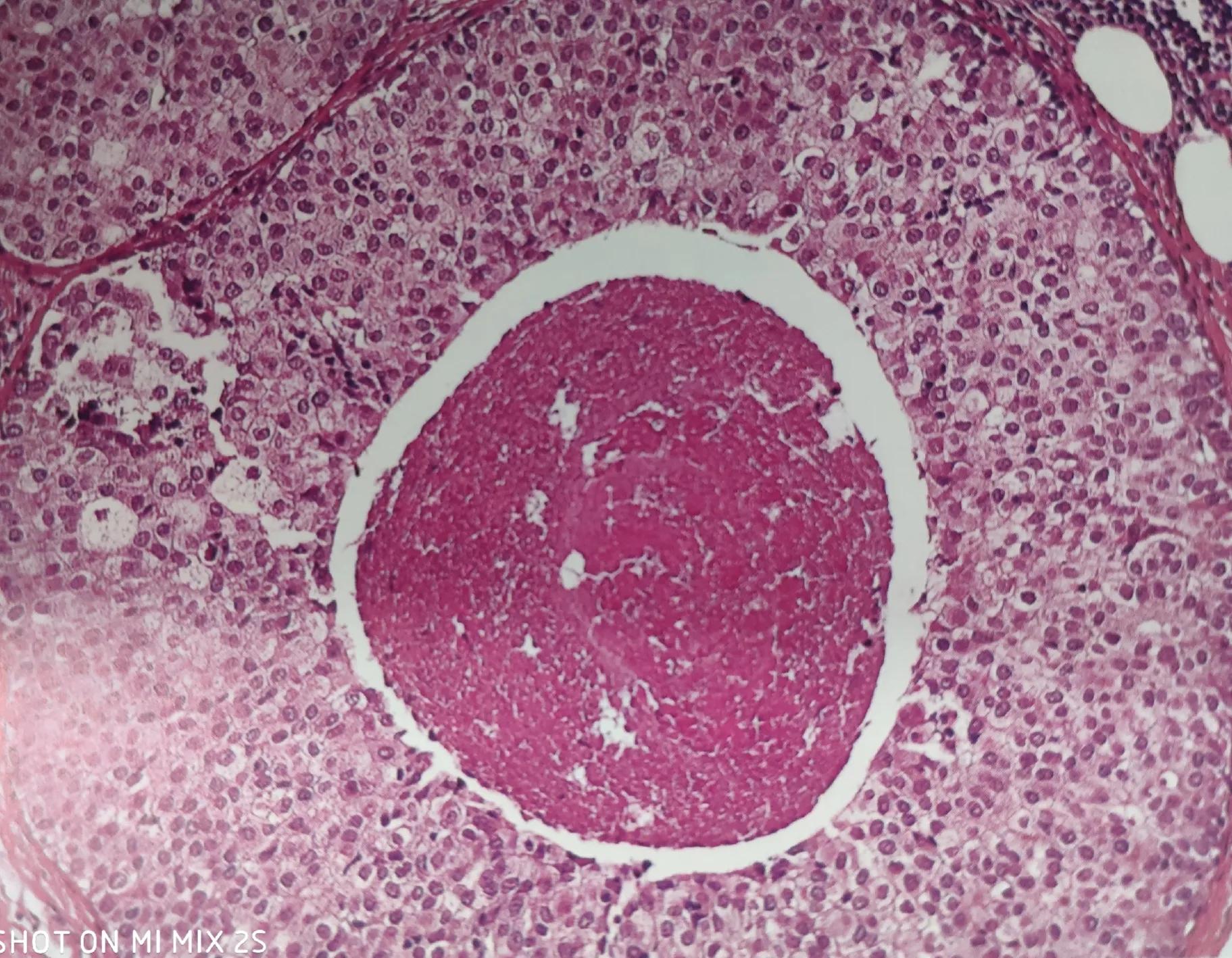 應引起重視的兩種原位癌——膀胱原位癌和乳腺高級別導管內癌 - 資訊咖