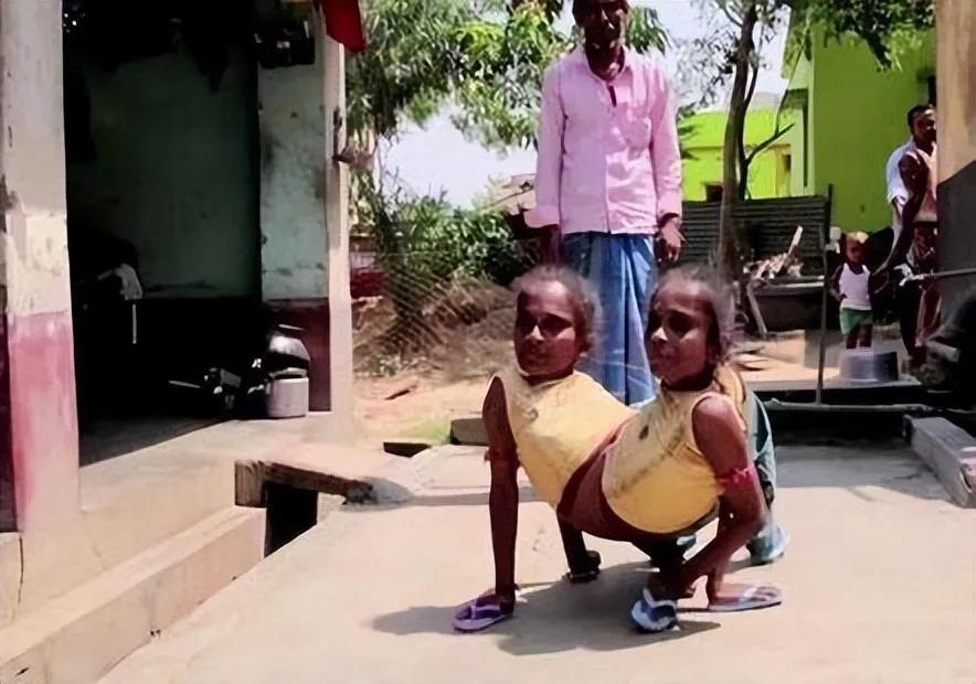 Indian Conjoined Twins Share The Lower Body And Marry The Same Husband Husband I Love Them 5306