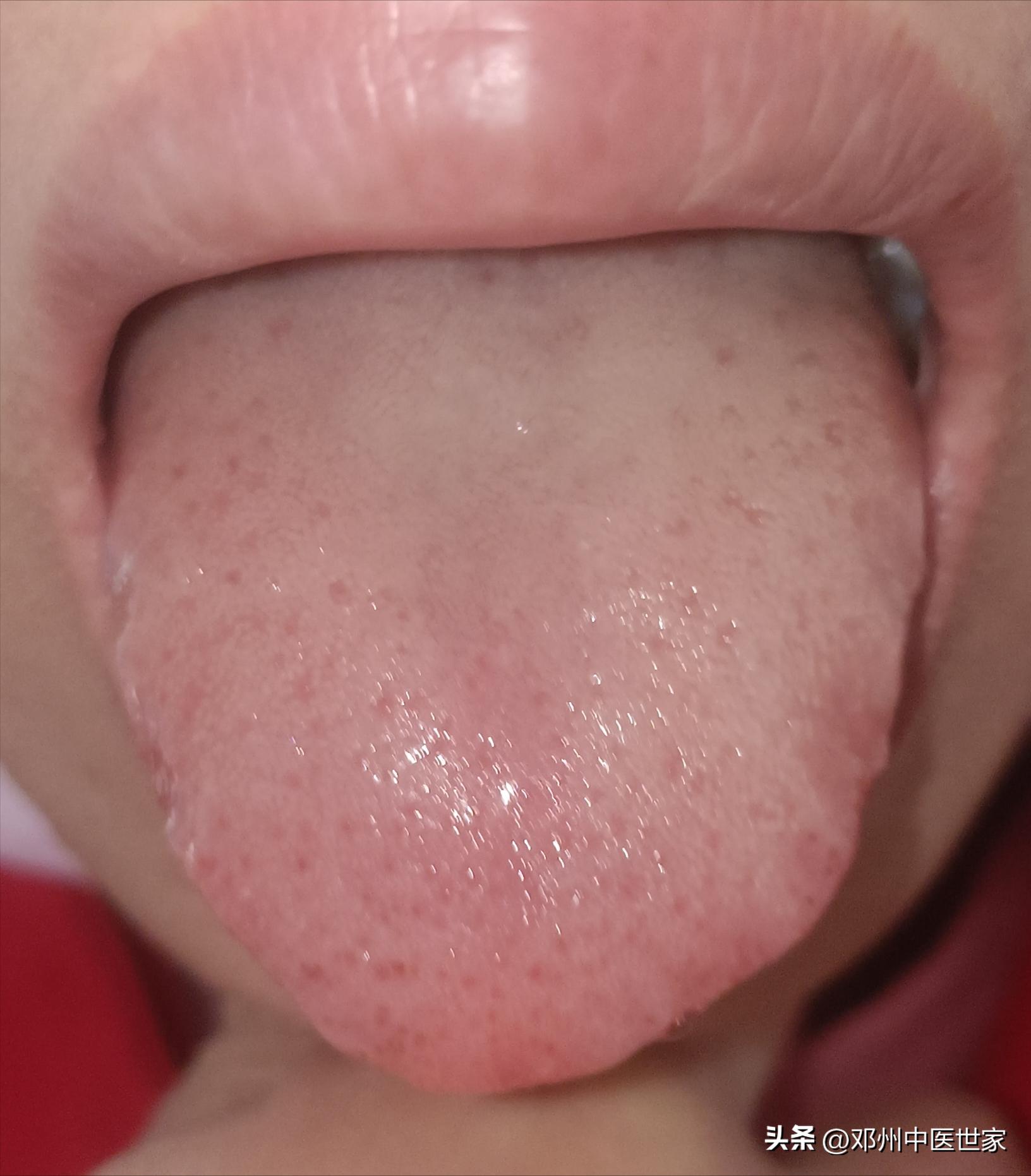 Coughing yellowgreen thick phlegm iNEWS