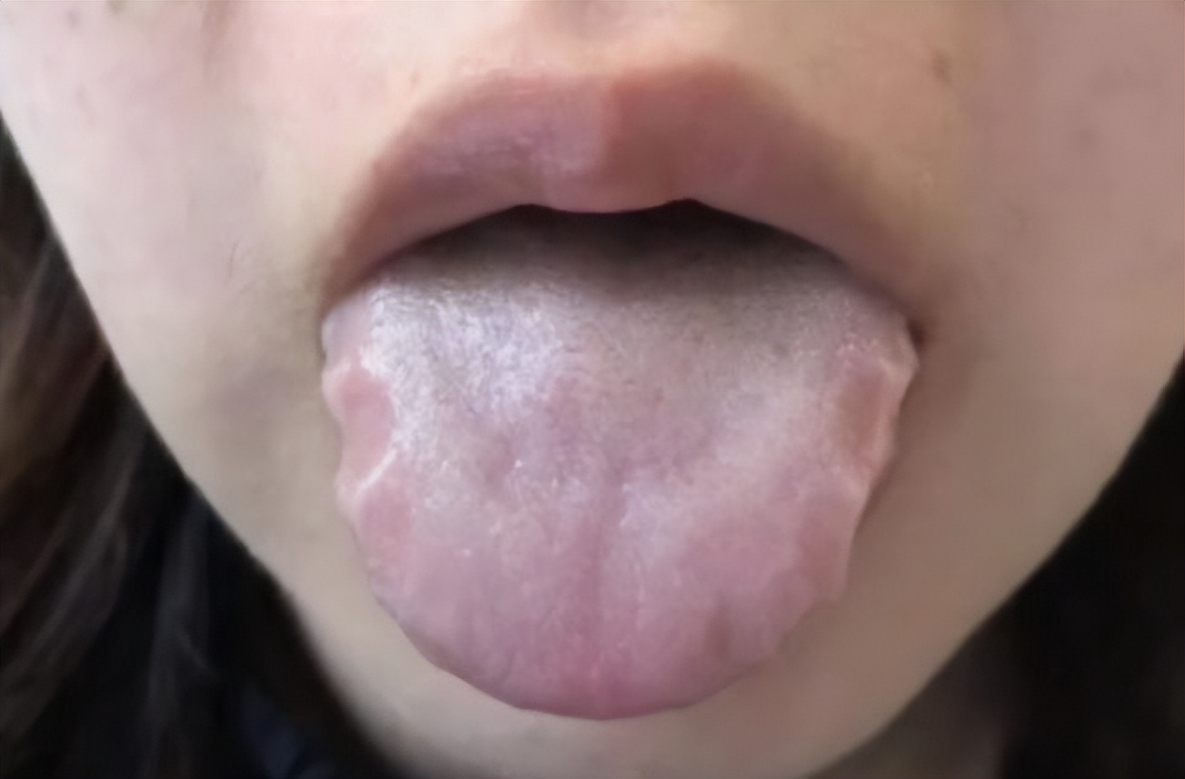 There are teeth marks on both sides of the tongue. Is it due to spleen ...