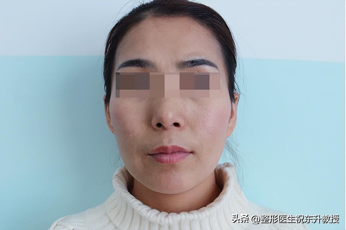 A full face makes you look younger!15day real record of autologous fat