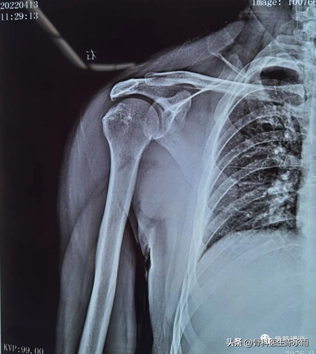 Arthroscopic repair of huge rotator cuff tear - iNEWS