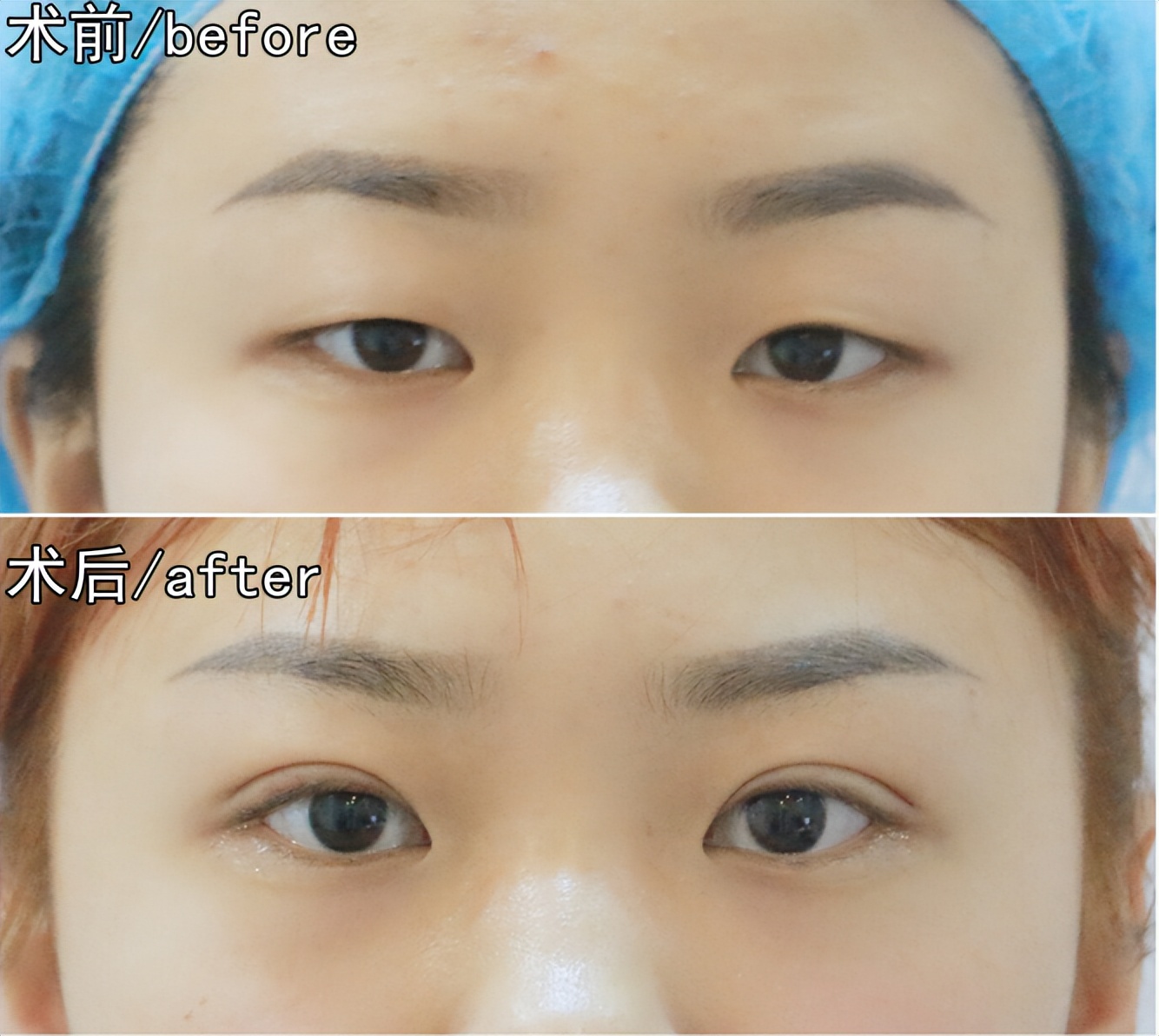 does-double-eyelid-surgery-hurt-inews