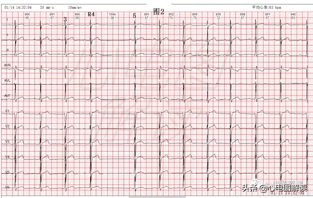 Causes of long RR intervals: missed beats?Asystole?block? - iNEWS