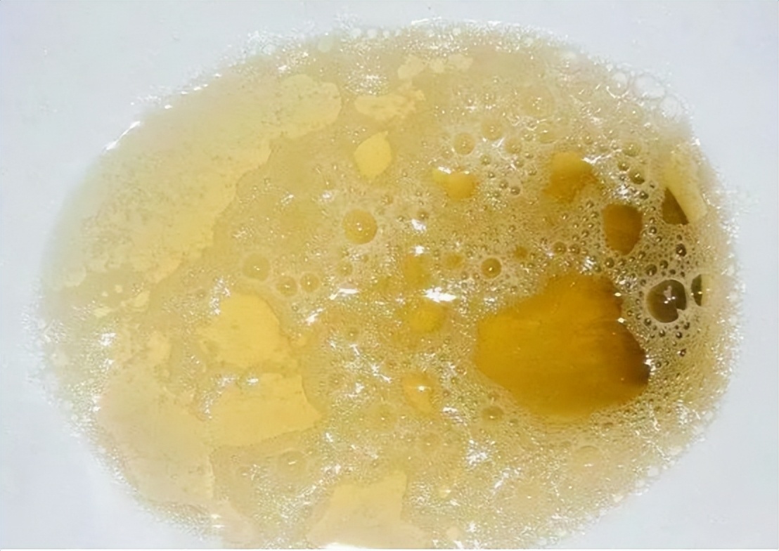 Is there a lot of foam in the urine a precursor to kidney failure? Or