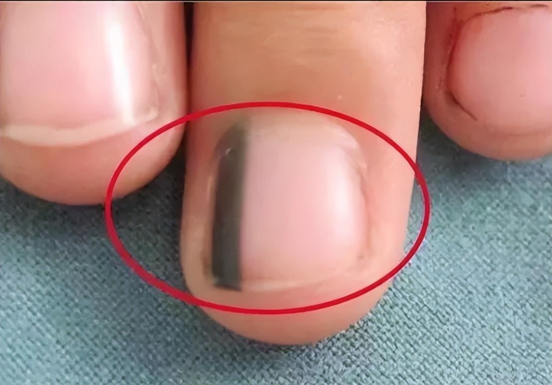 there-are-vertical-lines-on-the-nails-what-is-the-cause-is-it-the-old