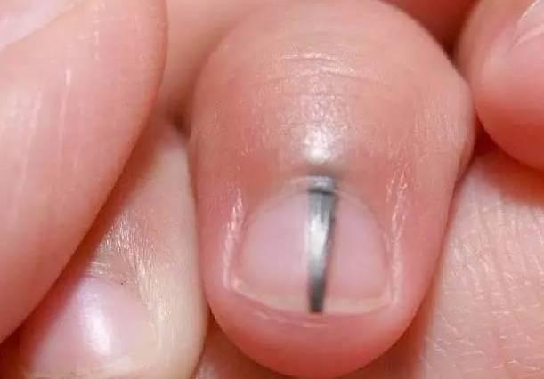 What do crescents, white spots and vertical lines on nails  represent?Doctors tell you the truth about nails and health - iNEWS