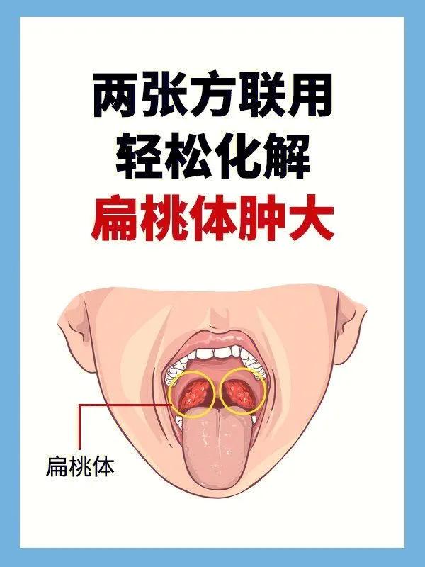 Use Two Prescriptions Together To Easily Resolve Swollen Tonsils INEWS   397b33d727c64b3599c6bdb69868d454 