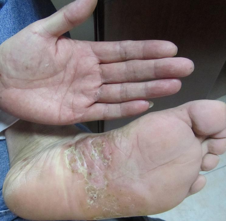 What is tinea pedis? - iNEWS