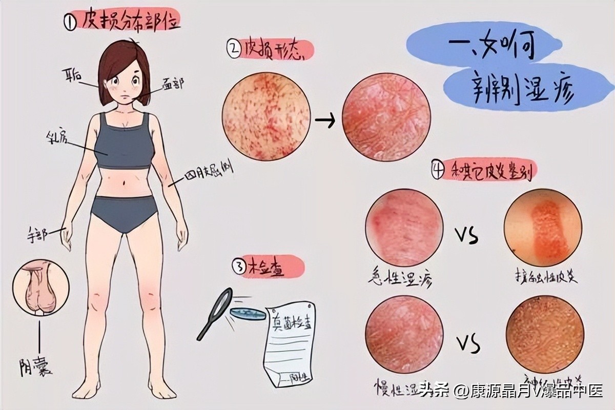 Acupuncture for eczema, chloasma, lethargy iNEWS