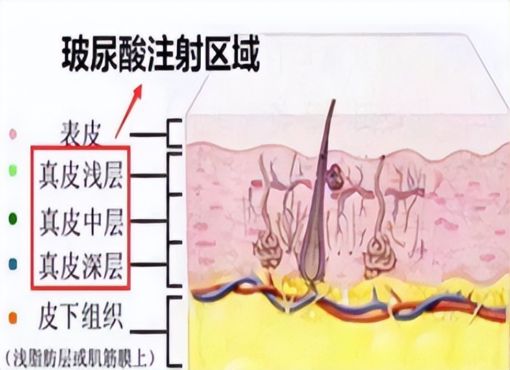 if-you-use-too-much-hyaluronic-acid-will-there-be-separation-of-skin