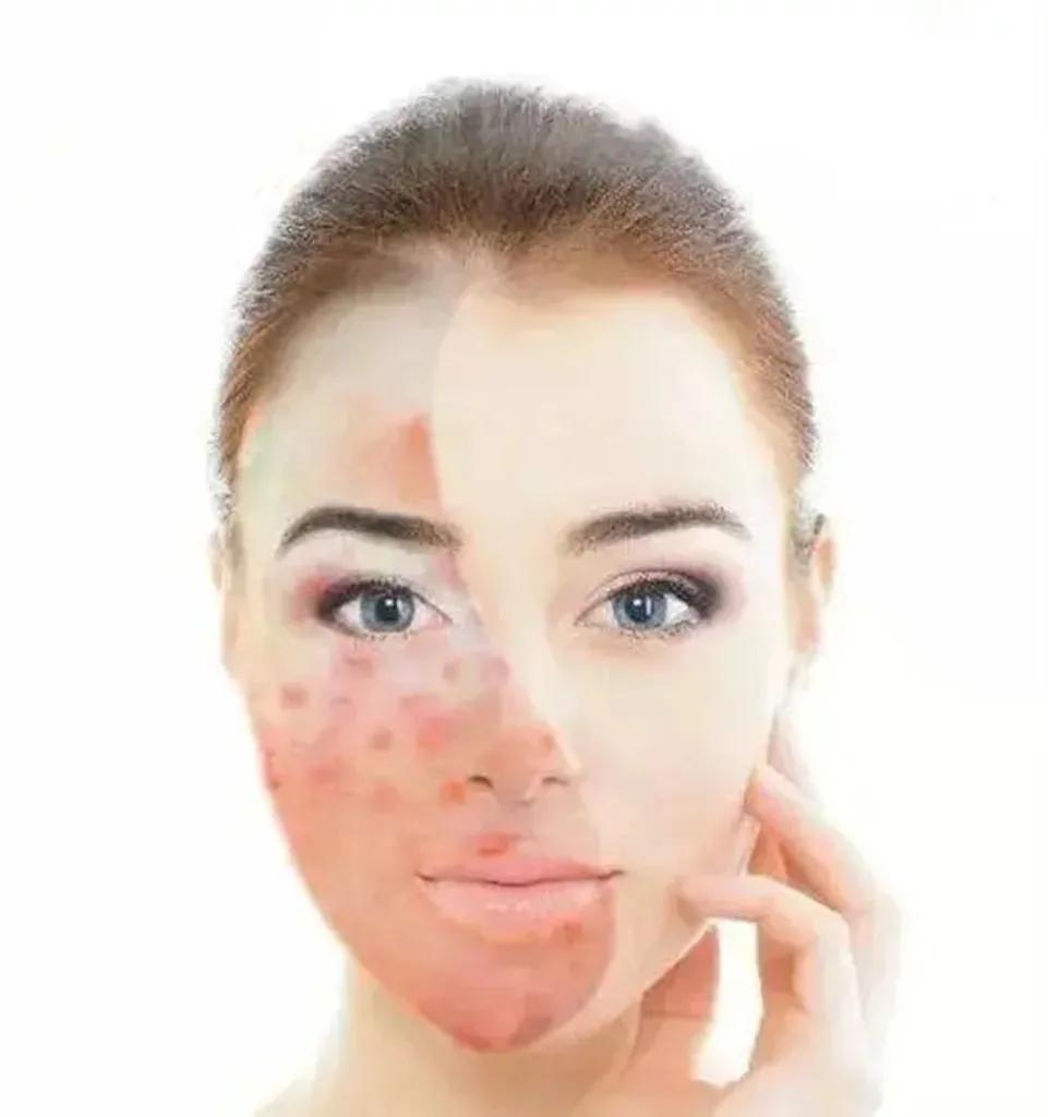 How to get rid of hormone face, please keep this kit iNEWS