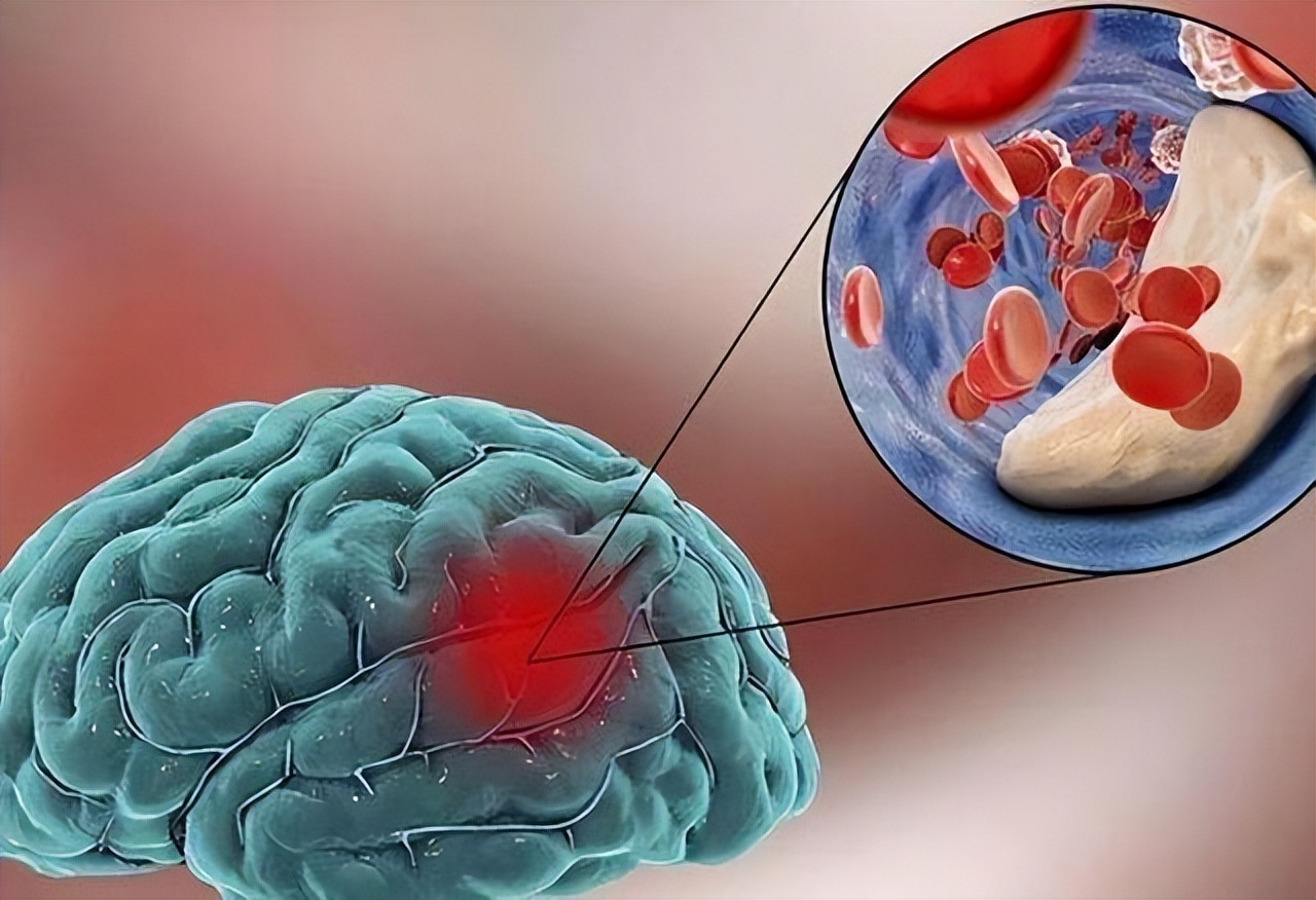 Лечение сосудов