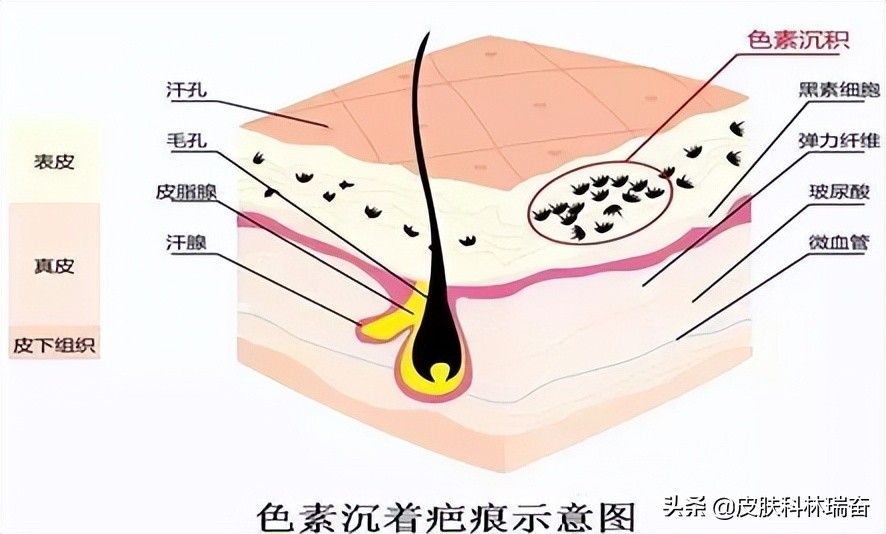 Does soy sauce really darken scars?What about pigmented scars?Detailed